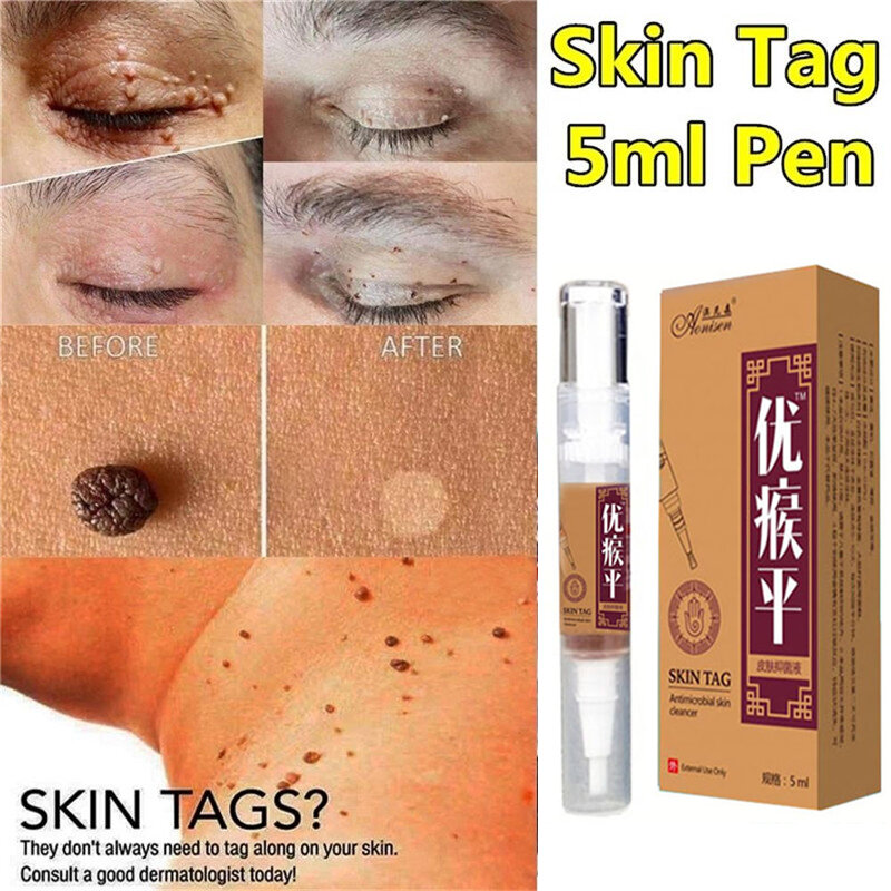 10ml/20ml Skin Tag Remover 12 hours Medical kill Remover Skin Tag Mole & Genital Wart Remover Foot Corn Removal