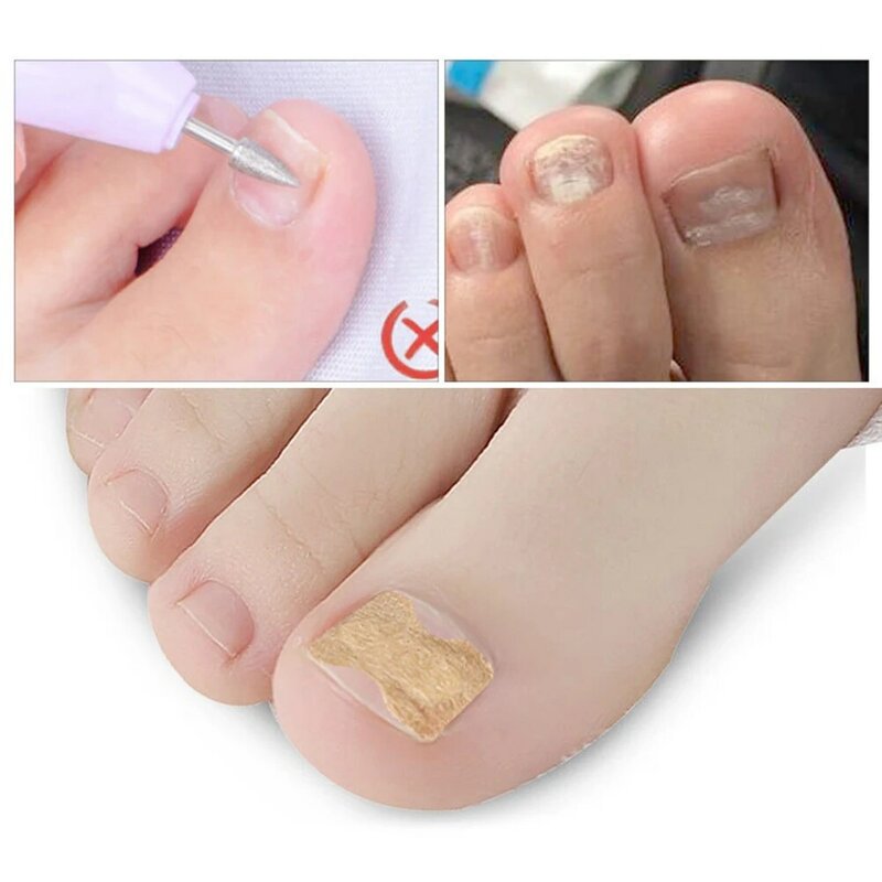 50Pcs Ingrown Toe Nail Correction Sticker Paronychia Foot Pedicure Corrector