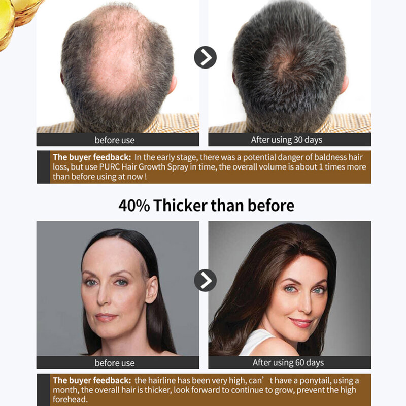 O tratamento natural do cabelo do pulverizador do crescimento do cabelo para o cabelo mais grosso mais grosso impede o pulverizador do recrescimento do cabelo da perda de cabelo
