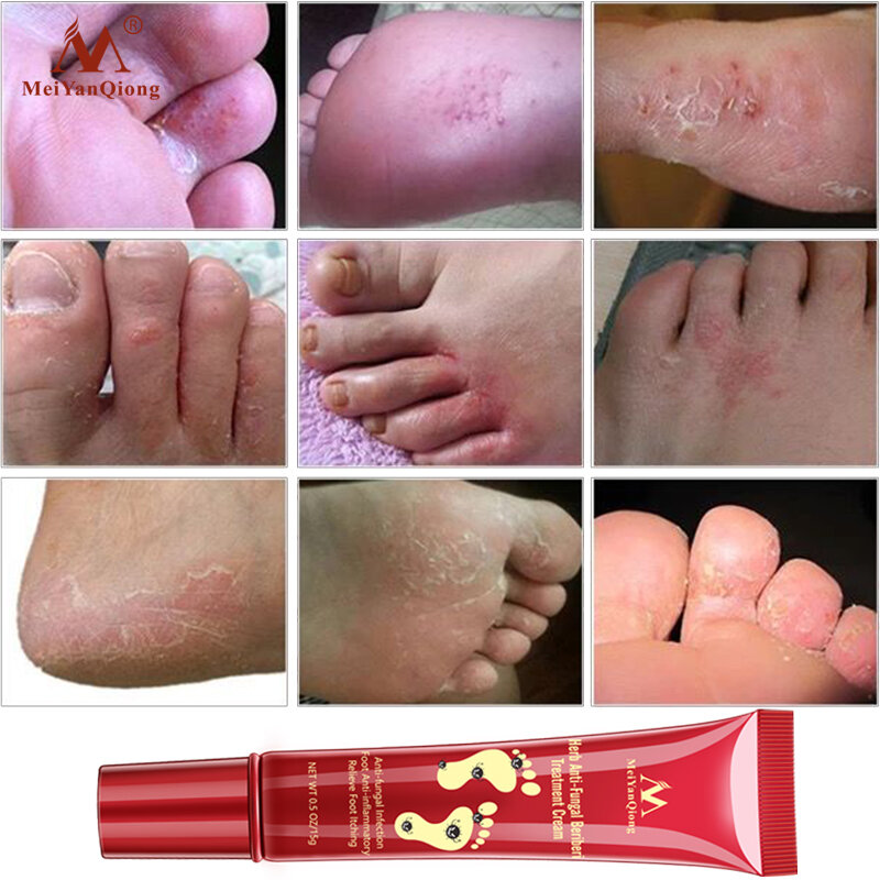 Tratamento de creme de pé eficaz erval anti infecção fúngica onychomycosis paronychia toe fungo gel reparação seco crack pés cuidados