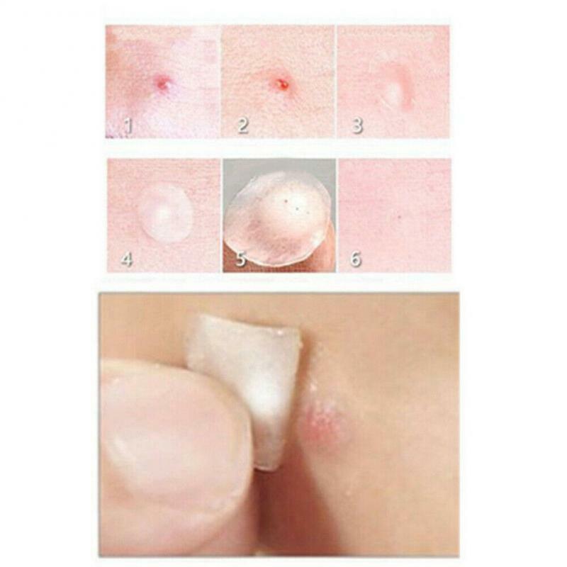 36 uds/hoja acné parche para espinillas Invisible acné pegatinas mancha para el acné tratamiento maestro grano removedor de herramienta de cuidado de la piel