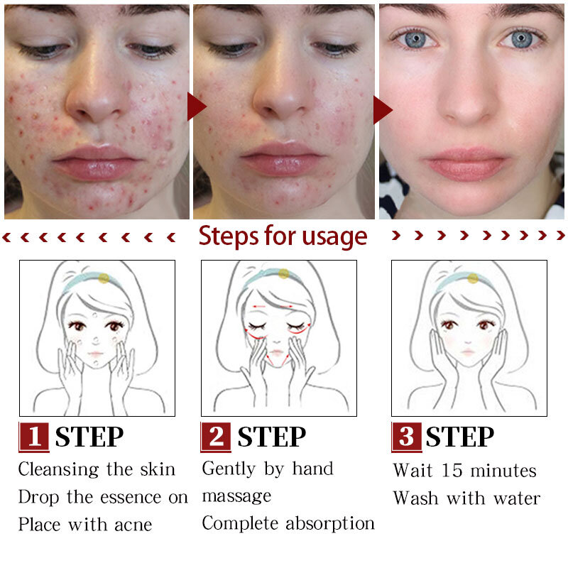 Akne Behandlung Gesicht Serum Centella Asiatica Öl Control Schrumpfen Poren Narbe Essenz Bleaching Feuchtigkeitscreme Hautpflege MeiYanQiong