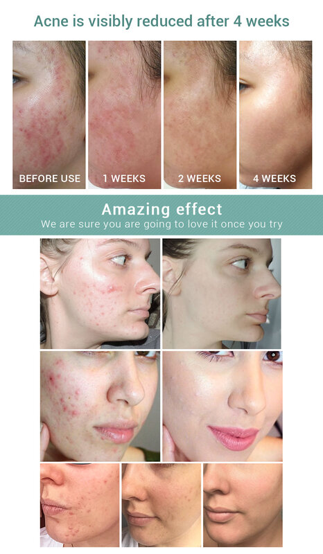 LANBENA-Crema de blanqueamiento del tratamiento del acné, Gel de reparación de espinillas, Control de aceite, reducción de cicatrices de poros, cuidado de la piel hidratante