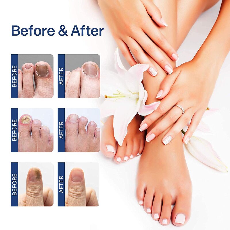 8PCS Nail Treatments Essence Feet Care Serum Nails Fungus Foot Fungal Removal Gel Anti Infection Paronychia Onychomycosis Repair
