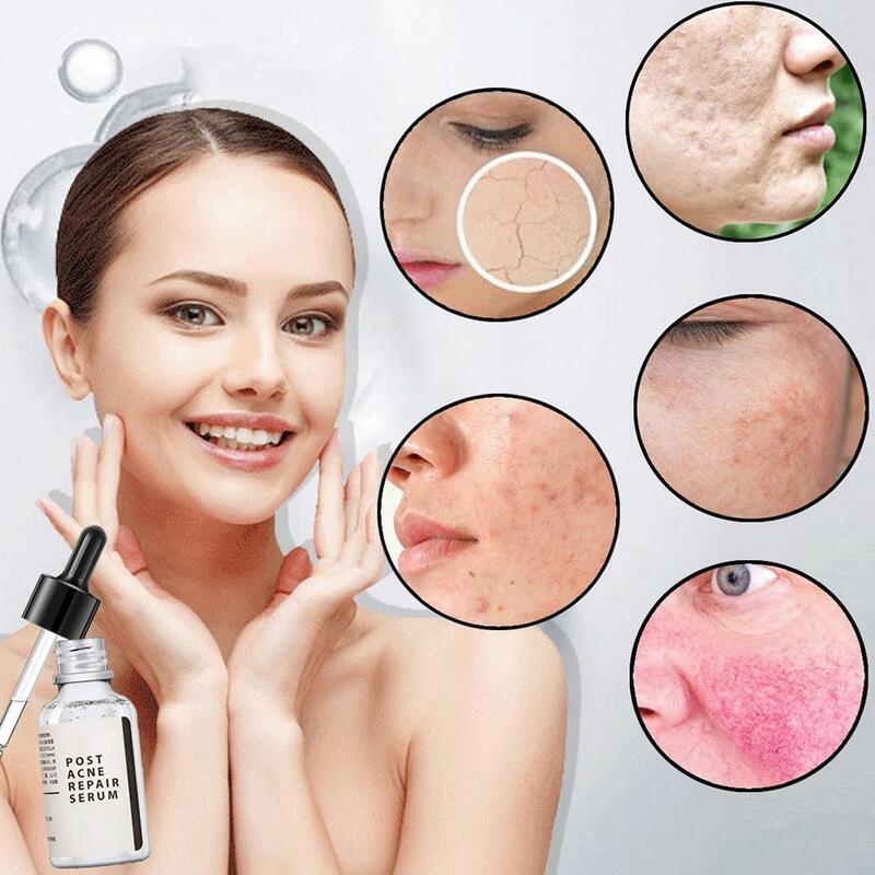 30ml Salicylic Acid 2% Solution Removes Acne Face Serum Shrinks Pore Moisturizing Essence Fade Spot Brighten Face Skin Care