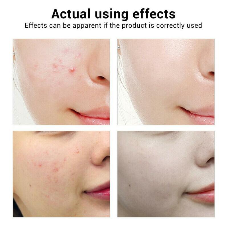 Ácido salicílico 2% solução remove acne 30ml, sérum facial para encolhimento dos poros hidratante mancha desbotada cuidados com a pele