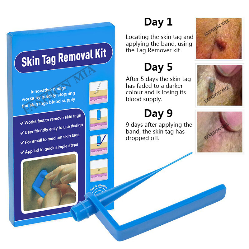 Micro Band ปลอดสารพิษ Face Care Mole Wart เครื่องมือขนาดเล็กถึงขนาดกลางสีฟ้า Skin Tag Removal ชุดทำความสะอาด swabs บ้านผู้ใ...
