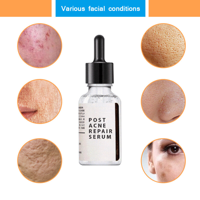 Essence éclaircissante pour réparation de l'acné, sérum pour le visage, rétrécissement des pores, éclaircissement de l'acné, soins de beauté