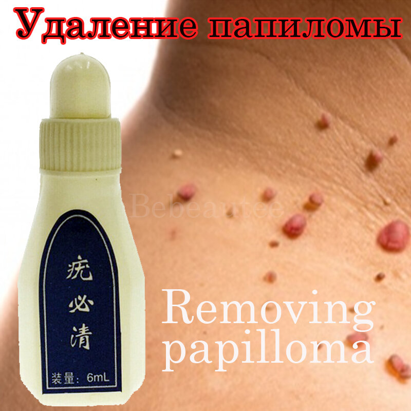 Genital Wart Treatment Papillomas Removal of Warts Draw Liquid From Skin Tags Removing Against Moles Remover Anti Verruca Remedy