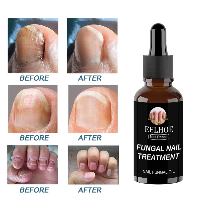 Onicomicosi riparazione unghie trattamento unghie fungine antimicotico anti fungo crema per la riparazione dei piedi cura delle unghie riparazione fluido accessori