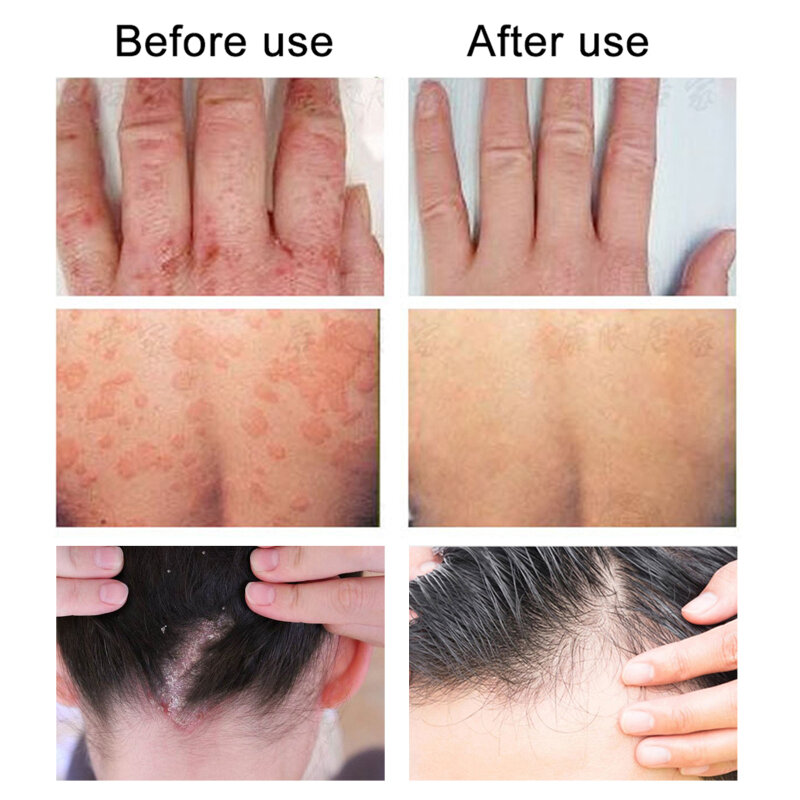 20ML Psoriasis Cream Dermatitis Eczema Skin Ointment Treatment of Itching Body Massage Skin Care Anti-itch Moisturizing Cream