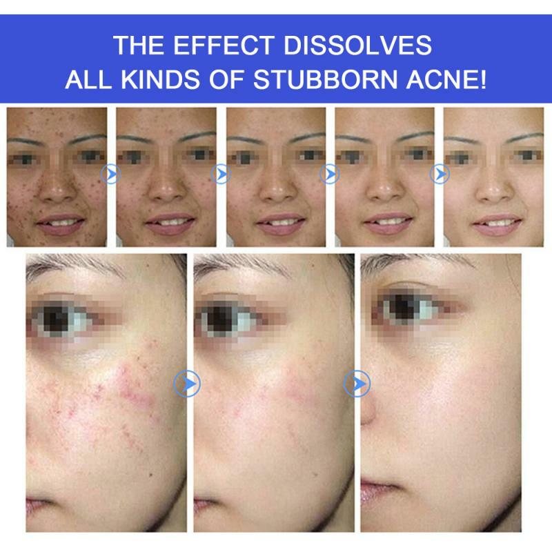 Medicina chinesa tradicional para o tratamento da acne, remova as marcas da acne, encolher os poros, clarear, creme hidratante do rosto