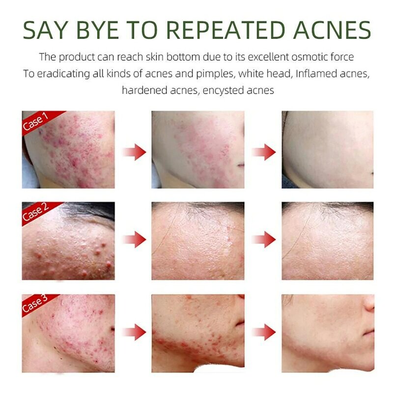 Remoção eficaz da acne creme erval anti-acne reparação desvanece-se manchas de acne de pele oleosa controle de óleo clareamento hidratante cuidados com o gel de rosto