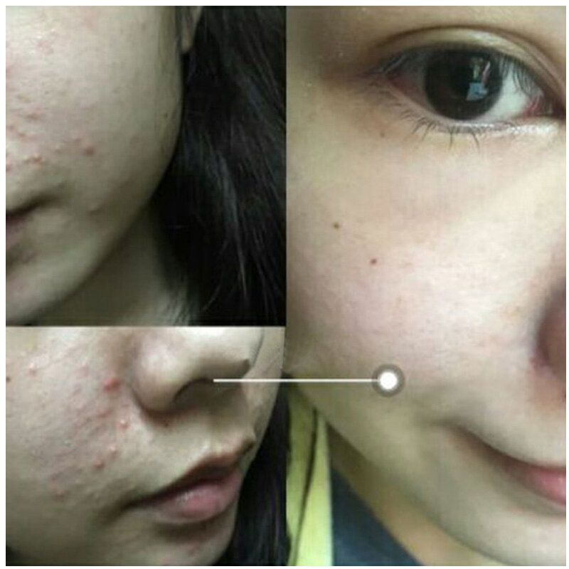 30ml solução de ácido salicílico 2% remove o soro da cara da acne encolhe a essência hidratante do poro desvanece-se o ponto ilumina o cuidado da pele do rosto