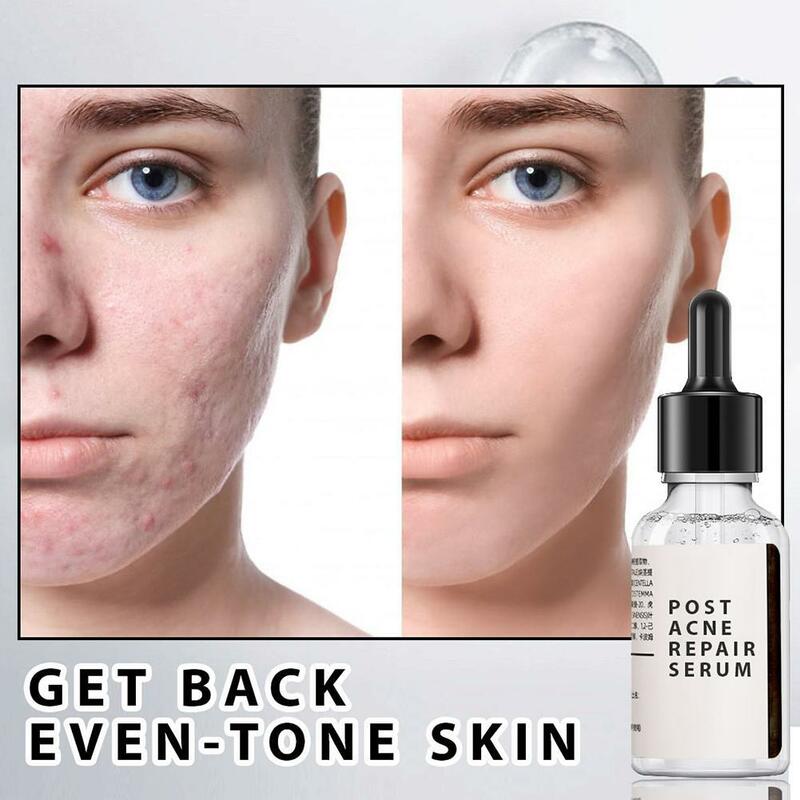 Ácido salicílico 2% solução remove acne 30ml, sérum facial para encolhimento dos poros hidratante mancha desbotada cuidados com a pele