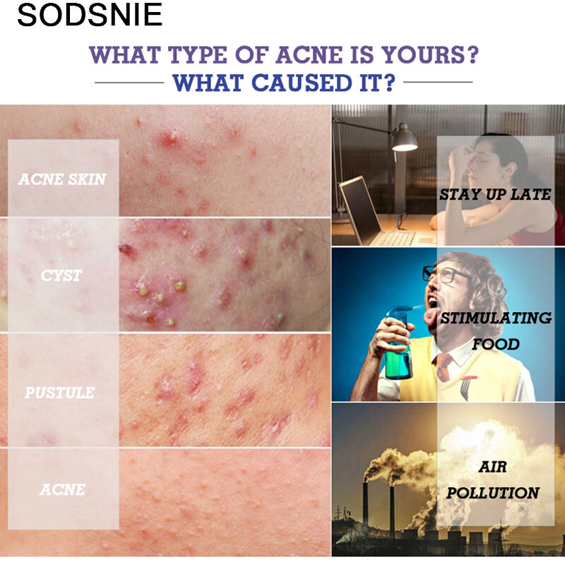 Aloe Beauty Acne Cream Moisturizing Lighten Acne Oil Control Remove Acne Scars Shrink Pores Soothing Repair Damaged Skin 20g