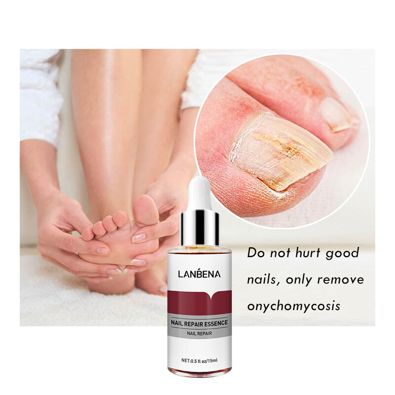 LANBENA Fungus Nail Serum Fungal Toe Nail Repair Essence Treatment Repair Onychomycosis Soften Brighten Hand Foot Nail Care 12ml