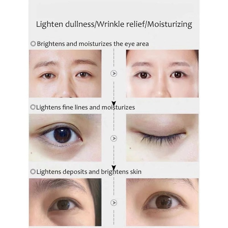 OUSFI หกเปปไทด์ไฟฟ้า Eye ครีมรังสีอินฟราเรด Saccharomyces Bifidus เซรั่ม Anti-Wrinkle Aging Moisturizing Eye Care 50G
