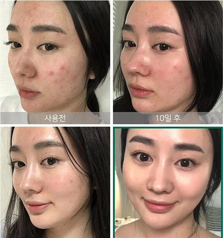 Roushun-sérum Miracle thé, Essence, Toner, 120ml, traitement de l'acné, élimine les points noirs, lotion blanchissant pour la peau du visage