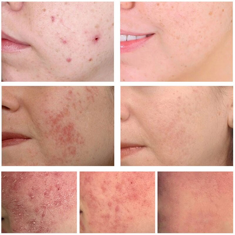Danshen creme de remoção da acne anti tratamento da acne desvanece-se manchas escuras espinhas controle de óleo poros limpos hidratante clareamento cuidados com a pele