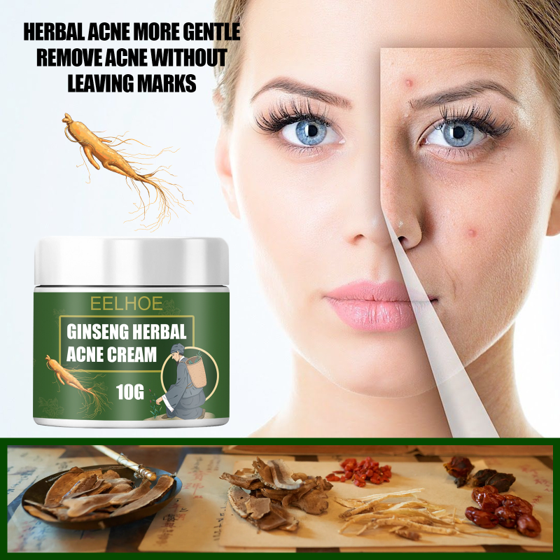 Crema de eliminación efectiva de acné, Gel facial hidratante blanqueador para el cuidado de la piel, a base de hierbas, antiacné, Control de manchas de acné