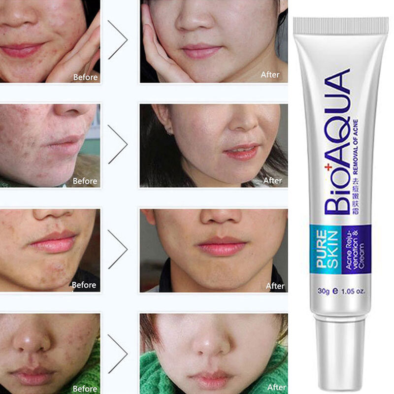 BIOAQUA-Crema para eliminar cicatrices y acné, tratamiento antiacné, crema blanqueadora facial, Control del aceite, se desvanece, minimiza los poros y las manchas oscuras, cuidado de la piel