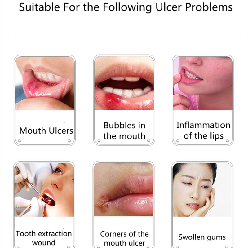 15g Oral Geschwür Salbe Relief Lippen Blasenbildung und Entzündung Geschwollene Zahnfleisch Chinesische Medizinische Linderung Mund Geschwüre Creme