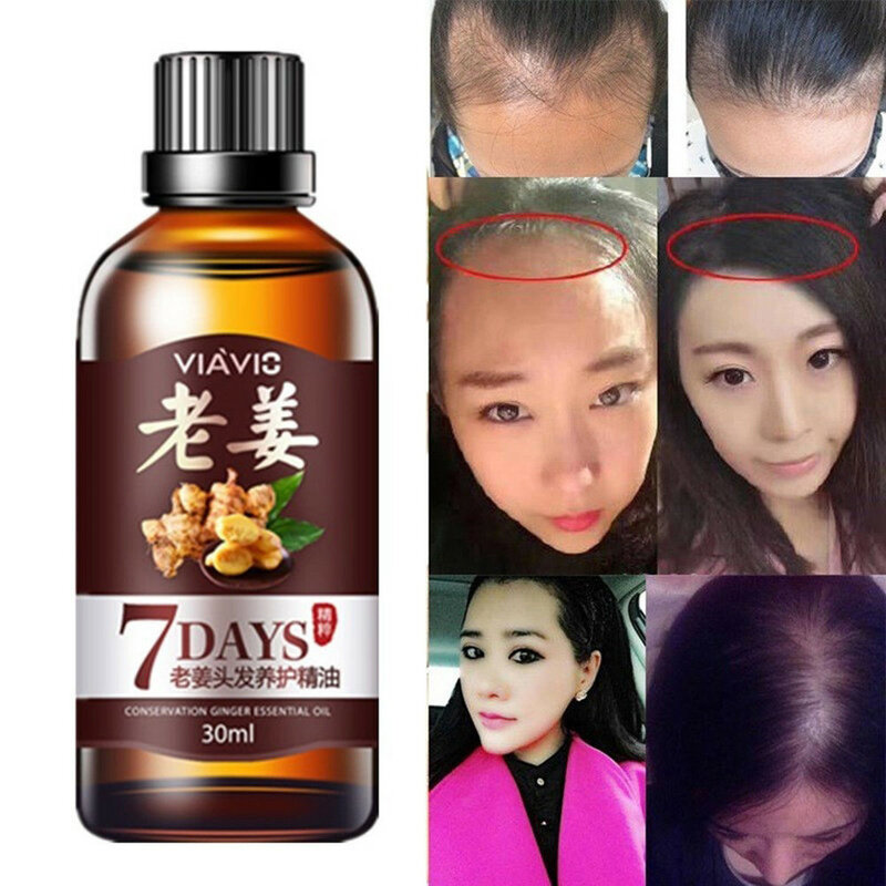 Aceite de jengibre para el crecimiento del cabello, suero nutritivo y saludable para el cuidado del cabello, pérdida de cabello tratamiento Anti, rebrote denso rápido, 30ML