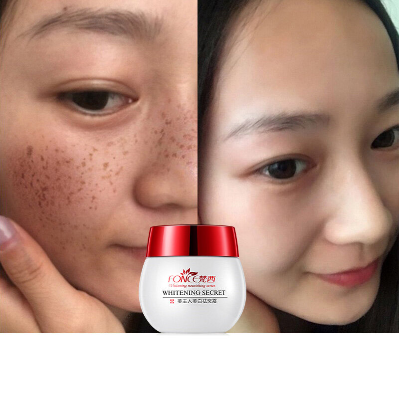 Fonce Whitening Freckles Cream 30g powerful spot remover anti Aging Dark Spots Fade Beauty Face Cream