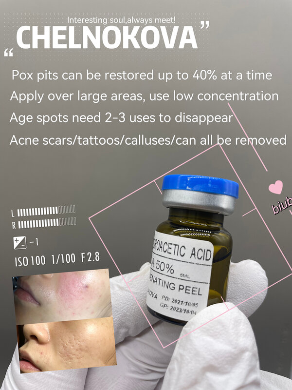 Kit de eliminación de piel TCA 20%, 5ml, ácido tricloroacético, elimina etiquetas de la piel, manchas de la edad, manchas blancas, estrías, envío gratis