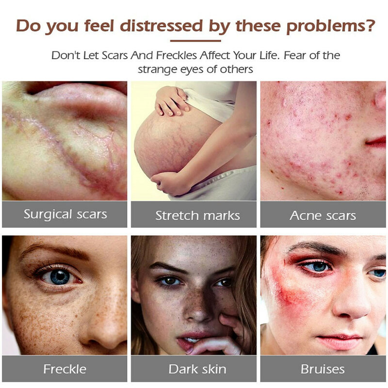 Remoção eficaz da cicatriz da acne creme tratamento acne estrias espinhas manchas reparação gel clareamento alisamento cuidados com a pele do corpo 30g