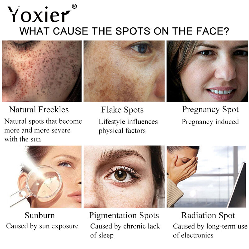 Yoxier crema viso sbiancante anti-lentiggine rimuovi Melasma Spot macchie scure pigmentazione idratante nutriente illumina la cura della pelle