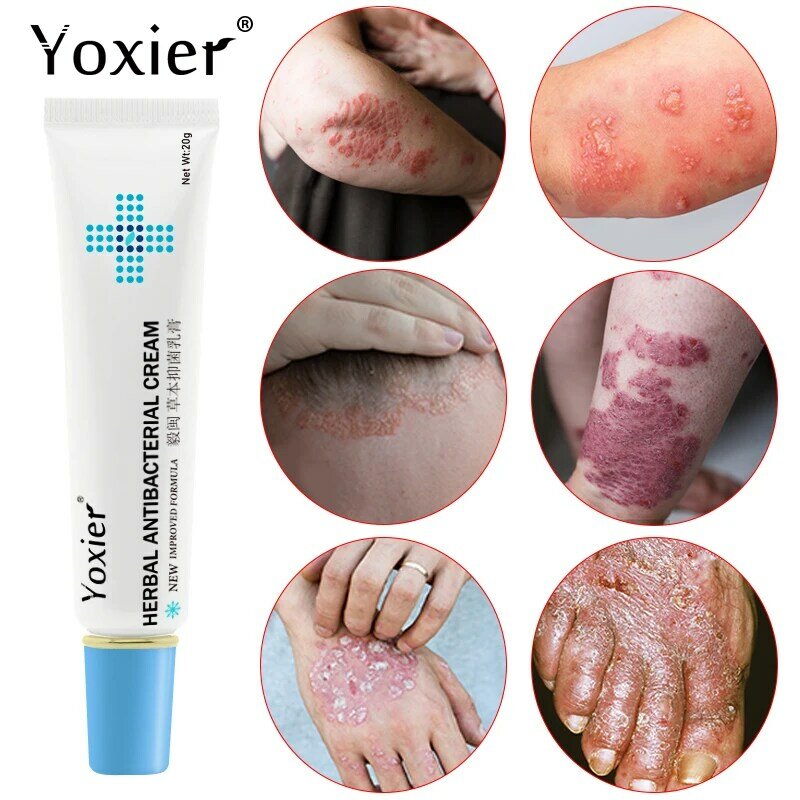 Yoxier Herbal Antibacterial Cream, Psoriasis, Itching Relief, Eczema, Rash, Urticaria, Peeling Treatment, External Skin
