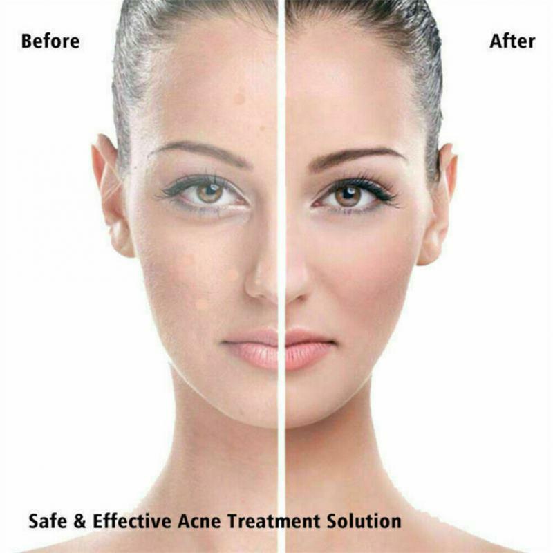 36 unids/set profesional acné parche para espinillas mancha lugar máscara Facial acné grano removedor de pegatinas para la belleza de la piel, herramientas para el cuidado de