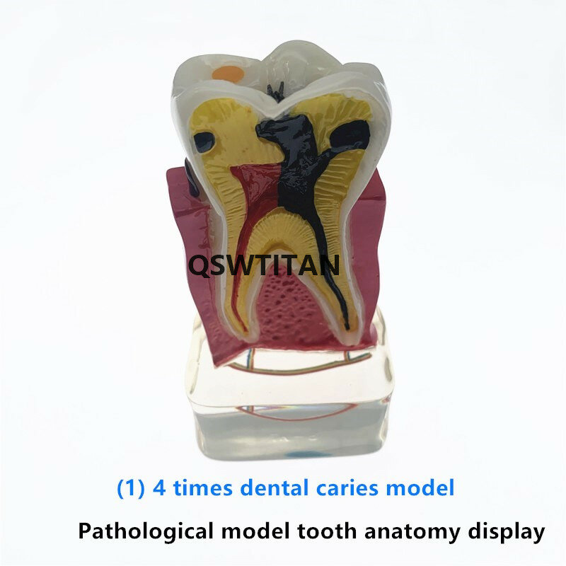 치과 연구 교육 치아 모델 치아 질병 모델