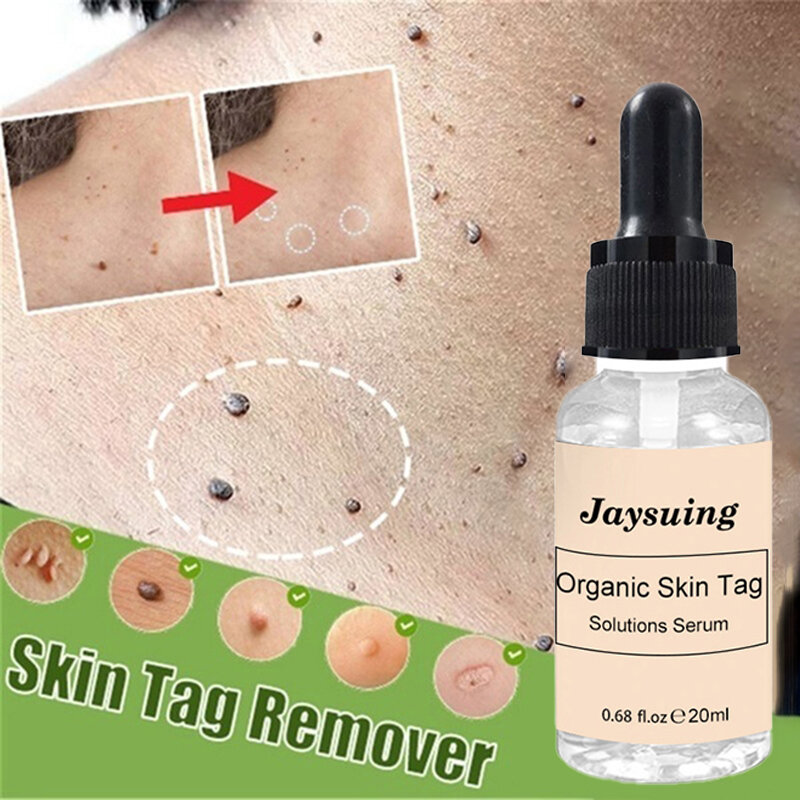 10/20ML soluzioni per etichette organiche siero Skin Tag Remover siero indolore talpa pelle macchia scura rimozione lentiggine crema olio intonaco