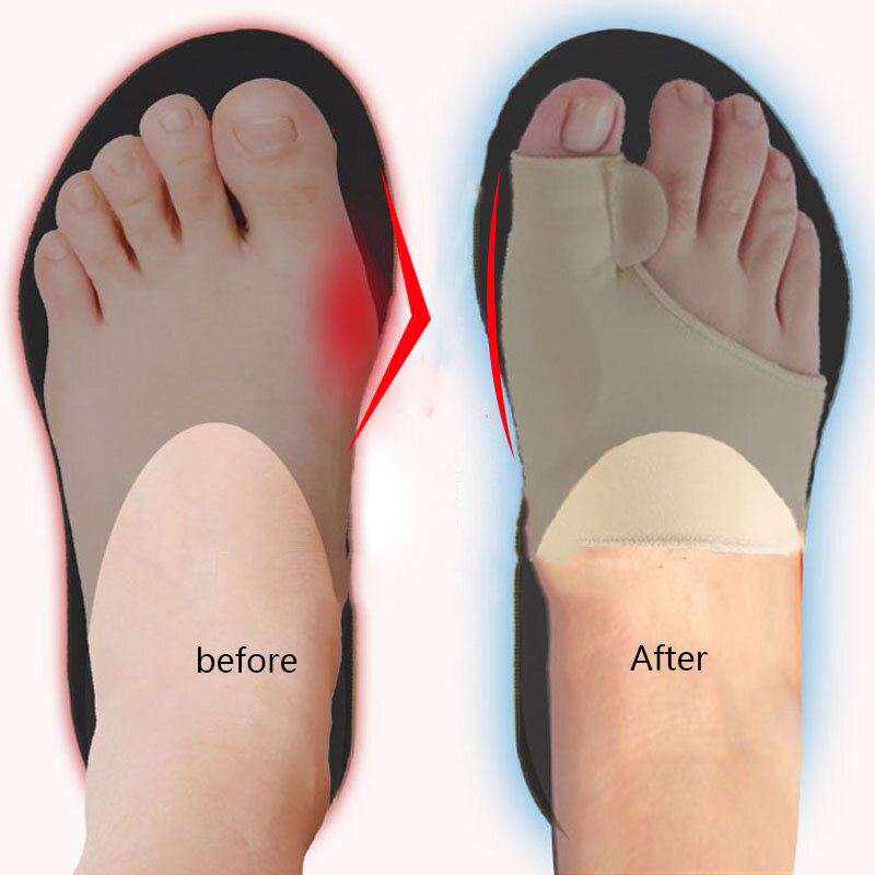 Dedo do pé grande tala separador hallux valgus bunion corrector orthotic pés cuidados polegar ajustador correção pedicure meias straightener