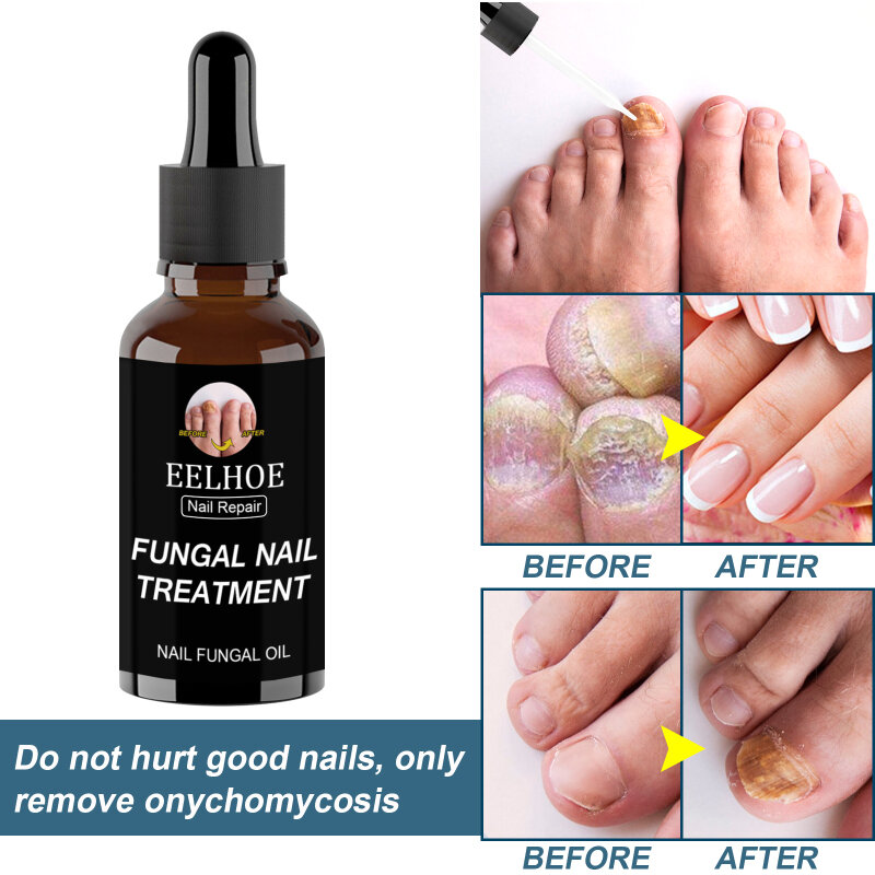 Cuidado eelazada-Tratamiento de hongos para uñas, reparación líquida, tratamiento de uñas, antihongos, crema reparadora de dedos de los pies