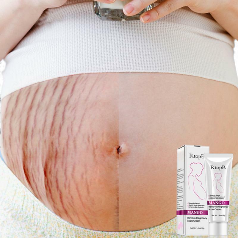 Hotsale manga remover cicatrizes de creme de gravidez acne marcas tratamento reparação eficiente saúde maternidade cuidados beleza da pele