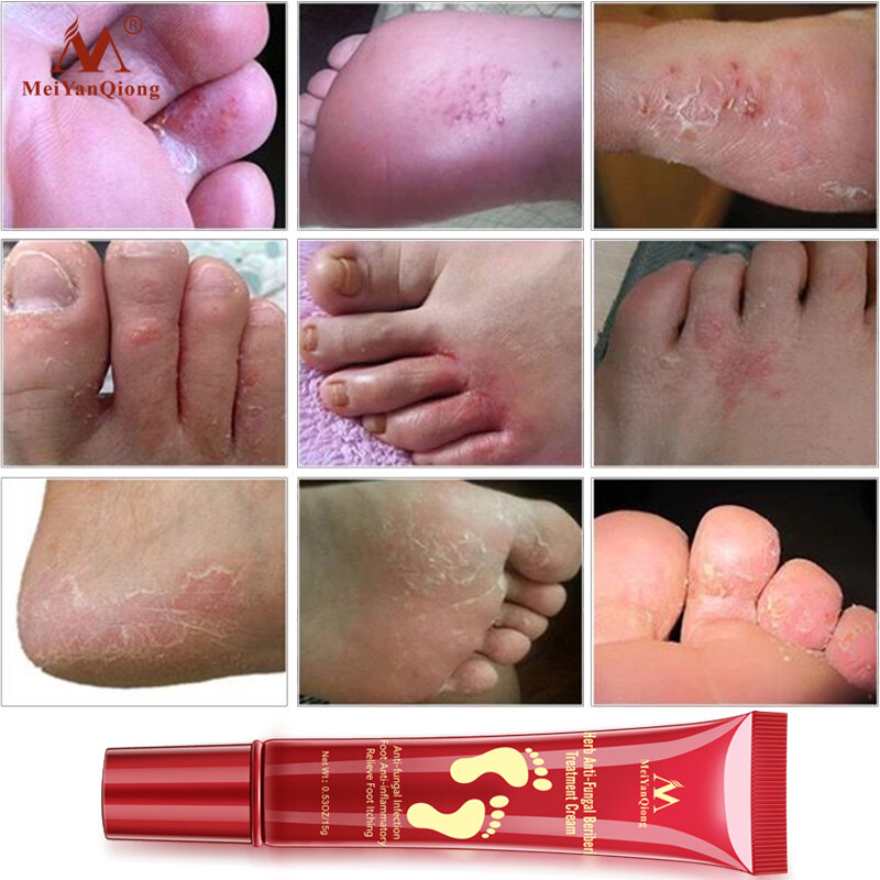 Creme de pé seco crack pés cuidados hidratante clareamento anti infecção fúngica onychomycosis dedo do pé fungo creme gel reparação creme 15g
