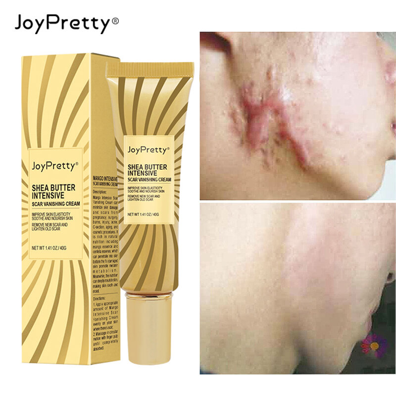 JoyPretty-crema facial para eliminar cicatrices y acné, Corrector de pigmentación, Gel blanqueador alisador facial, hidratante, cosméticos, cuidado de la piel