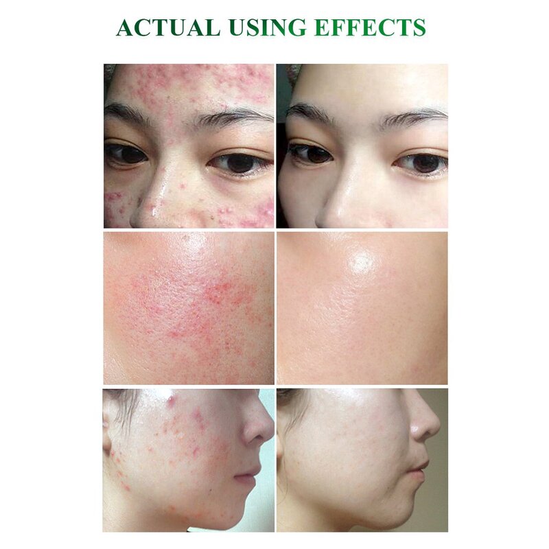 BREYLEE 2Pcs สำหรับ Acne Treatment Serum และ Anti-Acne Cream ชุดกำจัดสิวสิวสิว Whitening Moisturizing Skin care