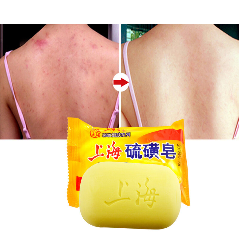 Jabón de azufre de Shanghai, Psoriasis de acné, 4 condiciones de la piel, Eczema de seborrea, antihongos Perfume, mantequilla, baño de burbujas, 85g, 10 unidades