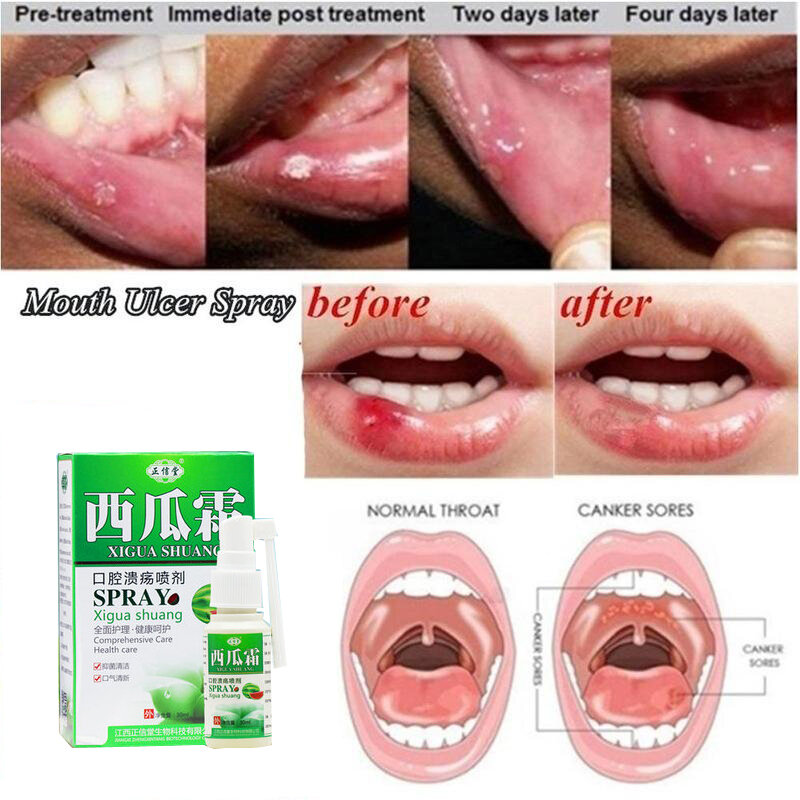 Natural herbal oral spray oral cleansing freshener antibacterial ulcer toothache treatment relief pain oral ulcer spray 30ml