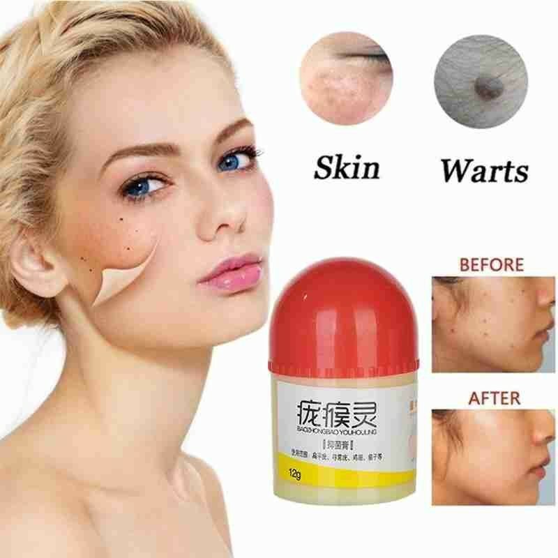Wart Treatment Papillomas Removal of Warts Liquid From Skin Tags Removing Against Moles Remover Anti Verruca Skin Tag Remover