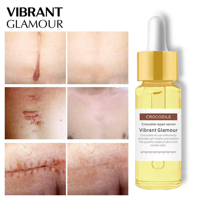 VIBRANT GLAMOUR Crocodile Repair Scar face serum Removal Acne Scar Whitening for Spots Acne Treatment Stretch Marks Skin Care