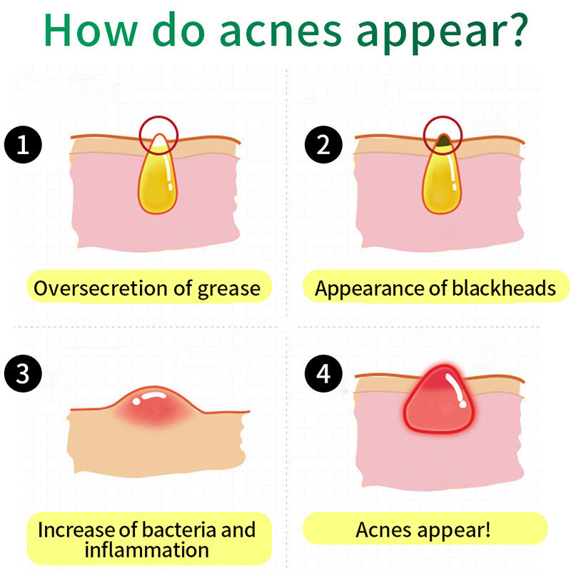 Breylee Acne Treatment Cream Gezicht Anti Litteken Verwijdering Huidverzorging Whitening Reparatie Puistje Remover Voor Acne