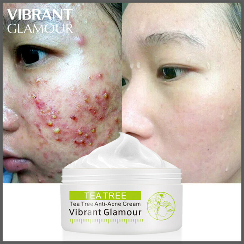 VIBRANT GLAMOUR-crema Facial con estampado de árbol de té, removedor de acné, tratamiento Facial que elimina el control de la grasa, cuidado de la piel