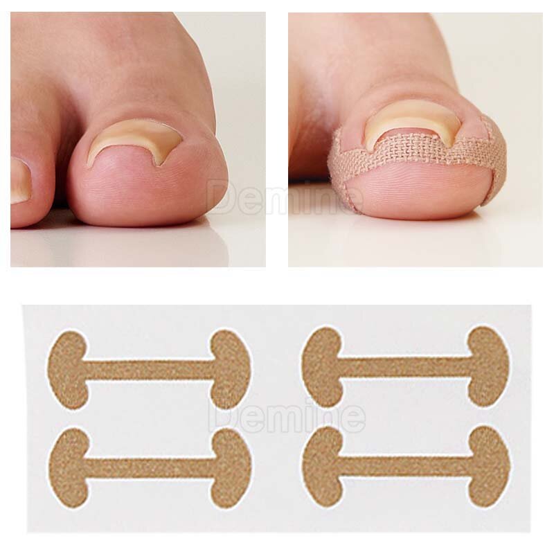 Ingrown Toenail Corrector Stickers Paronychia Treatment Recover Corrector Pedicure Tools Fingernail Toe Nail Care