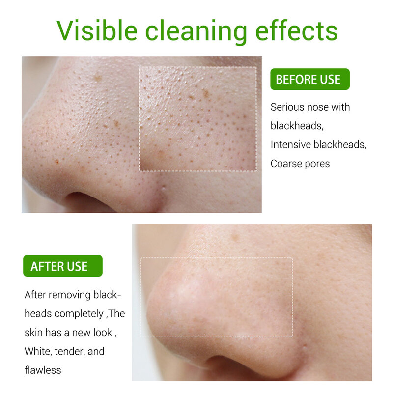 LANBENA – sérum d'élimination des points noirs, soin purifiant pour la peau, élimination douce des Pores en profondeur, traitement de l'acné, rétrécissement des Pores, 15m